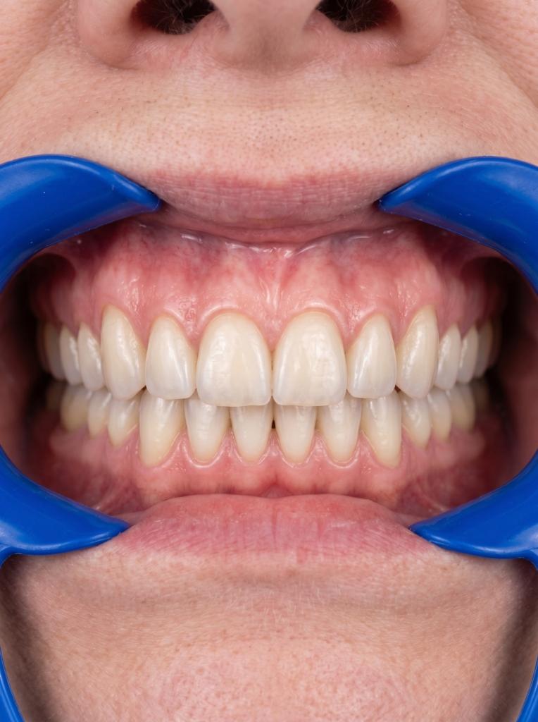 Clinical photo showing a perfect, natural-looking smile after All-on-4 full arch dental implants procedure