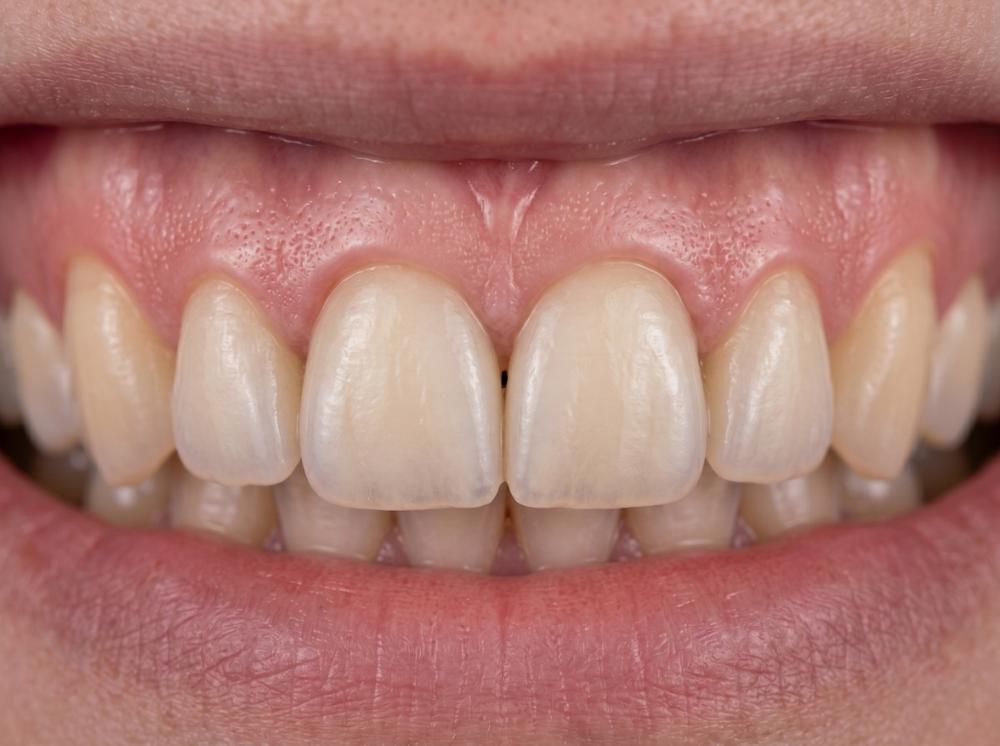 Real patient showing a beautiful, confident smile after full mouth dental implants in Philadelphia