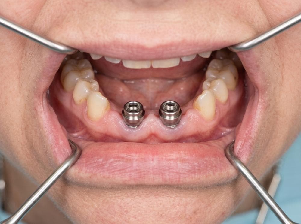 Locator abutments on dental implants for a snap-in denture